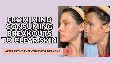 From Mind Consuming Breakouts To Clear Skin Katie Stewart Wellness