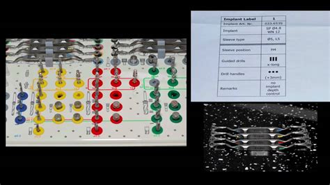 Guided Dental Implant Surgery Part 1 Youtube