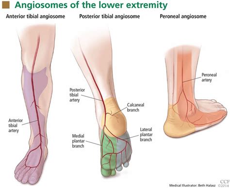 Personalized Approach To Revascularization Of Critical Limb Ischemia Circulation