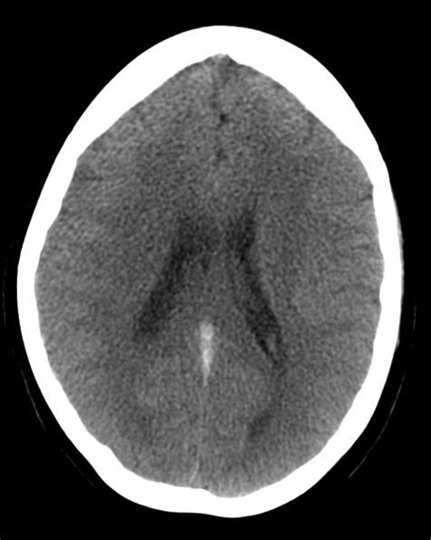 Trombosis Venosa Cerebral Radiodiagnosticando