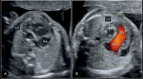 First Ever Genes Discovered To Cause Rare Congenital Heart Defect