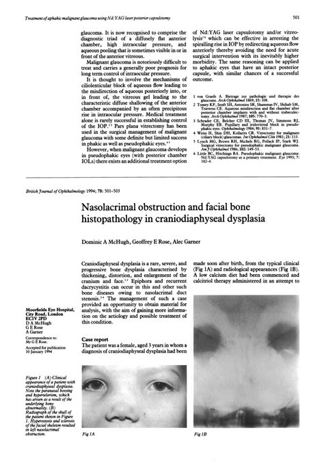 (PDF) Nasolacrimal obstruction and facial bone histopathology in craniodiaphyseal dysplasia