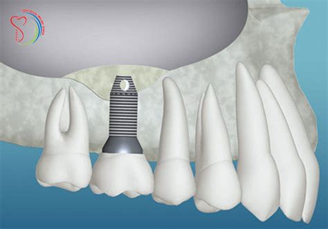 Dental Implant Combined With Sinus Lift And Bone Graft