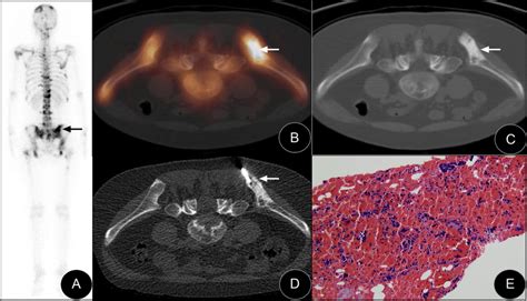 Spect Ct Guided Targeted Bone Marrow Biopsy In The Right Ilium