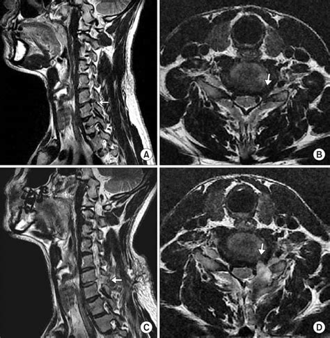 Posterior Cervical Microscopic Foraminotomy And Discectomy With Laser