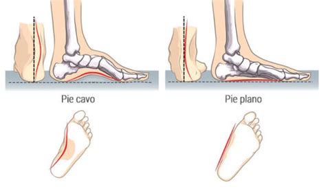 Pie Plano Y Pie Cavo Qu Son Cu Les Son Sus S Ntomas Y C Mo Podemos