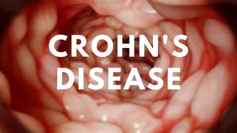 Crohns Disease Gastrointestinal Pathology Youtube