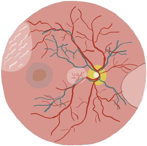 Retinal Detachment