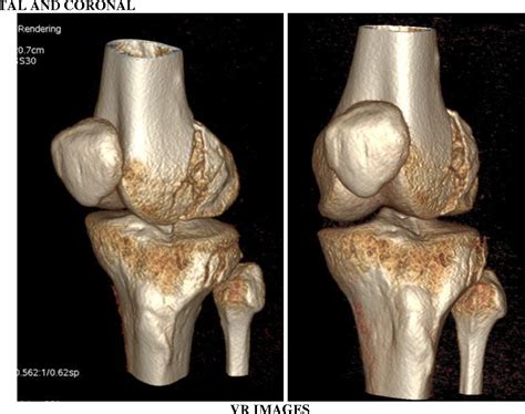 Figure 1 From Role Of 3 D Ct In Evaluation Of Tibial Plateau Fractures Semantic Scholar