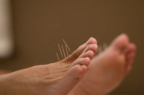 Neuropathy Can Acupuncture Help With Nerve Pain Acupuncture