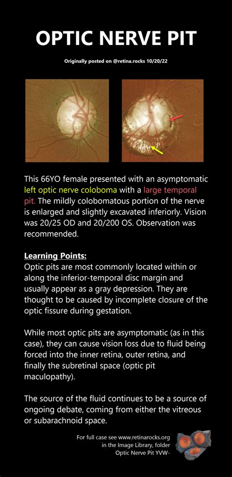 Optic Nerve Disorders Optic Nerve Pit And No Pit Retinoschisis Retina Rocks