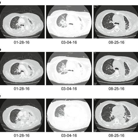 Chest Computed Tomography Scans At Diagnosis And After Treatment