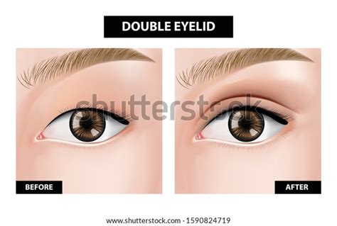 Double Eyelid Before After Vector Illustration Stock Vector (Royalty Free) 1590824719 | Shutterstock