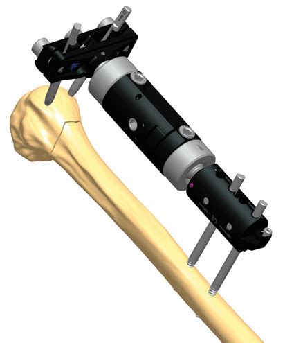 Humerus Fracture Treatments Orthofix Abs