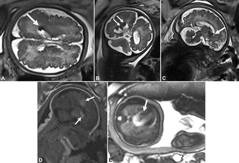 Case 2 Axial T2 Weighted Magnetic Resonance Image Half Fourier