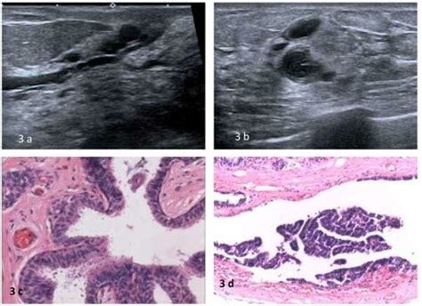 3a Ultrasound Showing Dilated Duct 2mm Or Ampullary Portion 3mm