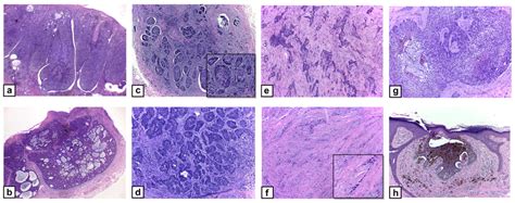 Histomorphological Characteristics Of Subtypes And Variants Of Bcc A