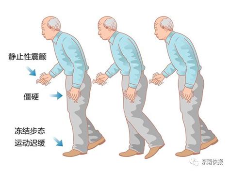 世界帕金森病日福建医科大学附属第一医院神经外科 运用ROSA机器人手术治疗帕金森病 机器人 手术 福建医科大学 新浪新闻