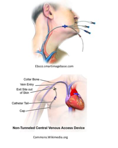 Non Tunneled Central Venous Catheter