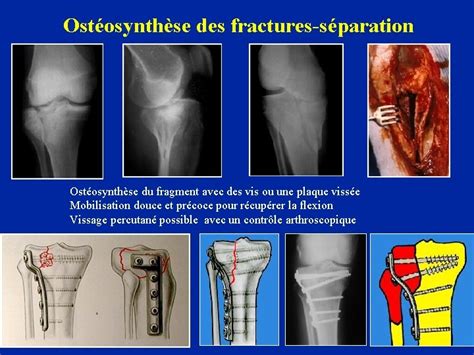 Fractures De Lextrmit Proximale Du Tibia Les Fractures