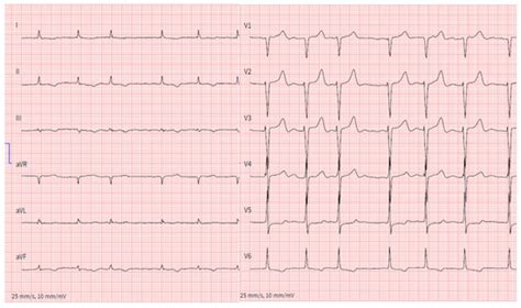 JCM Free Full Text Arrhythmic Manifestations Of Cardiac Amyloidosis