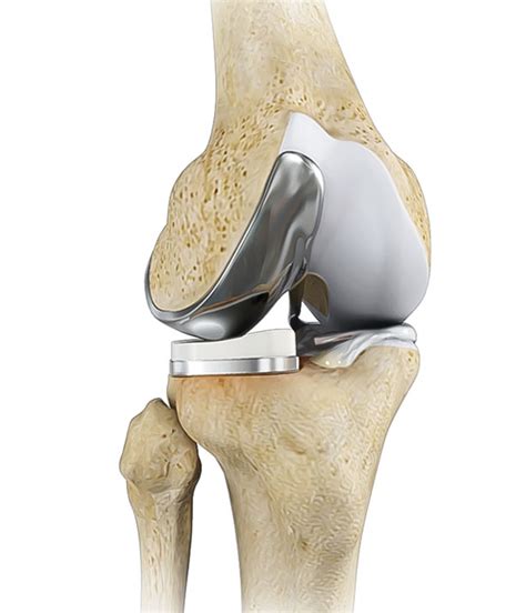 Partial Knee Replacement Dr Justin Chang