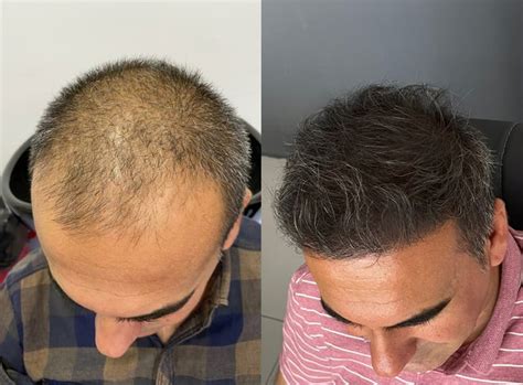 Hair Transplant In Mexico Tijuana Vatanmed Clinic