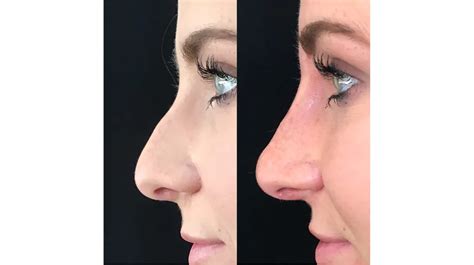 What Is Non Surgical Rhinoplasty Magazine Valley