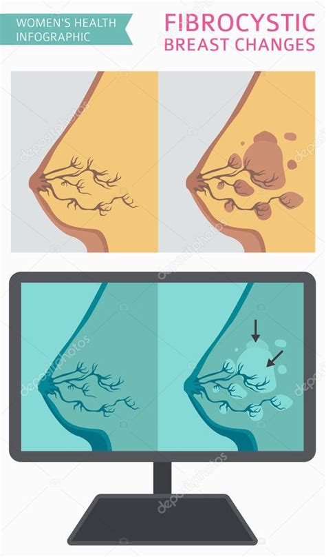 Fibroqu Stica Mama Cambia Enfermedad Infograf A M Dica Diagn Sticos