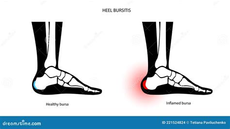 Bursitis Inflammation Concept Cartoon Vector Cartoondealer