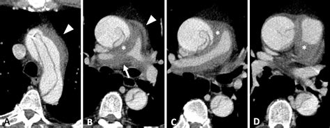 SciELO Brasil Hematoma Intramural da Artéria Pulmonar Associado a