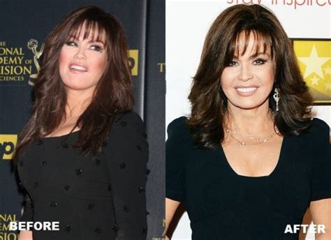 Marie Osmond Plastic Surgery: Before & After Photos ...