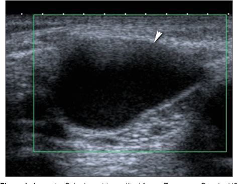 Figure From Ultrasound And Doppler Us In Evaluation Of Superficial