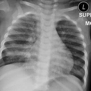 Anteroposterior Portable Chest Radiograph CXR Of An 11 Month Old