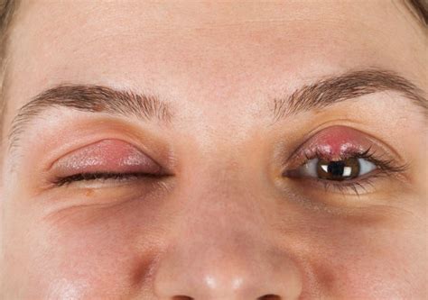 Stye Or Chalazion The Differences Between These Eye Diseases