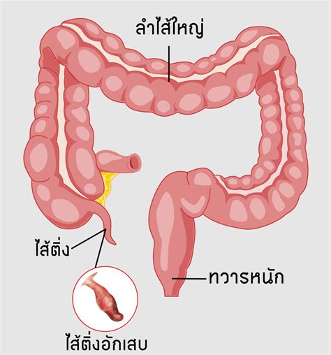 ปวดท้องอย่างไร เป็นไส้ติ่งอักเสบ Appendicitis โรงพยาบาลขอนแก่นราม