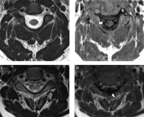 A 36 Year Old Woman With Relapsing Remitting Ms Rrms And Upper Download Scientific Diagram