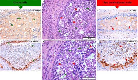 Morphological And Immunohistochemical Features Of The Gonadoblastoma