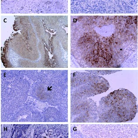 Immunohistochemical Analysis Of LSR Expression In Normal Urothelium And