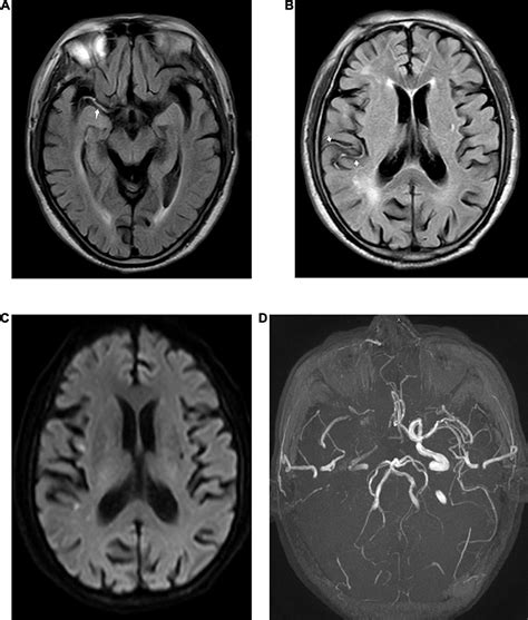 Frontiers Fluid Attenuated Inversion Recovery Vascular Hyperintensity