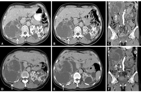 Serial Contrast Enhanced Computed Tomography Ct Scans Showing