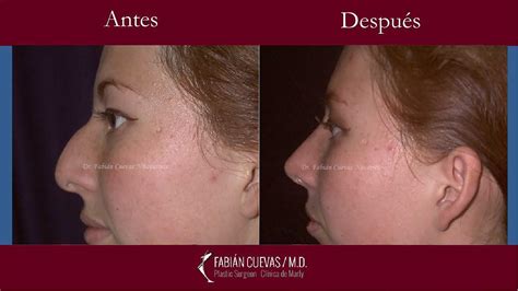 Rinoplastia Precios Cu Nto Cuesta Cirugia De Nariz Cu Nto Sale