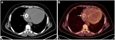 Frontiers Case Report A Primary Calcified Cardiac Mass In Right