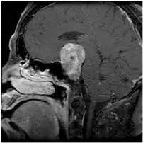 Pituitary Adenoma | Johns Hopkins Medicine