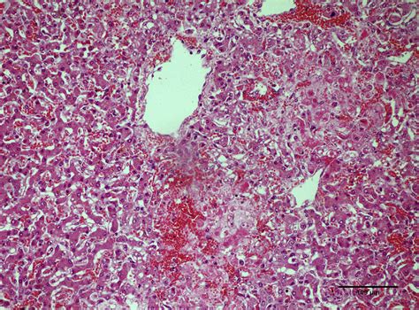 Coagulative Necrosis Gross