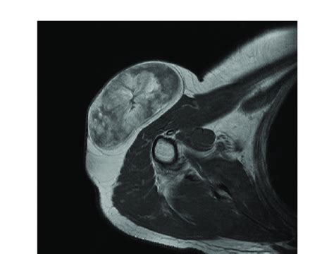 Liposarcoma Subcutaneous Liposarcoma Of The Shoulder Region As Seen On