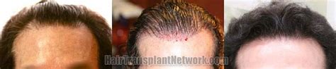 Dr Timothy Carman Hair Transplant Surgery Before And After Photographs