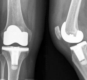 Knie Prothese Oefeningen En Behandeling Fysiotherapie All