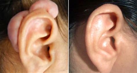 How To Safely Remove Keloid From Ear Piercings