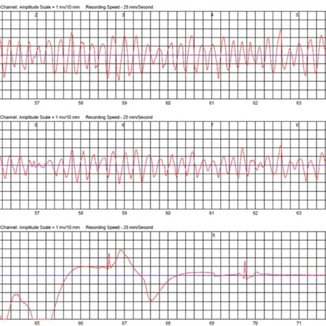 Sinus Tachycardia 160 Bpm With St Segment Depression Consistent With